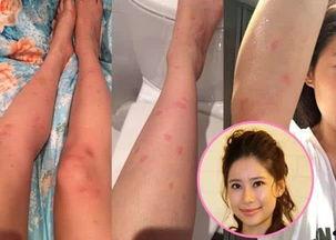 哪个明星被蚊子,明星遭遇“吸血鬼”瞬间